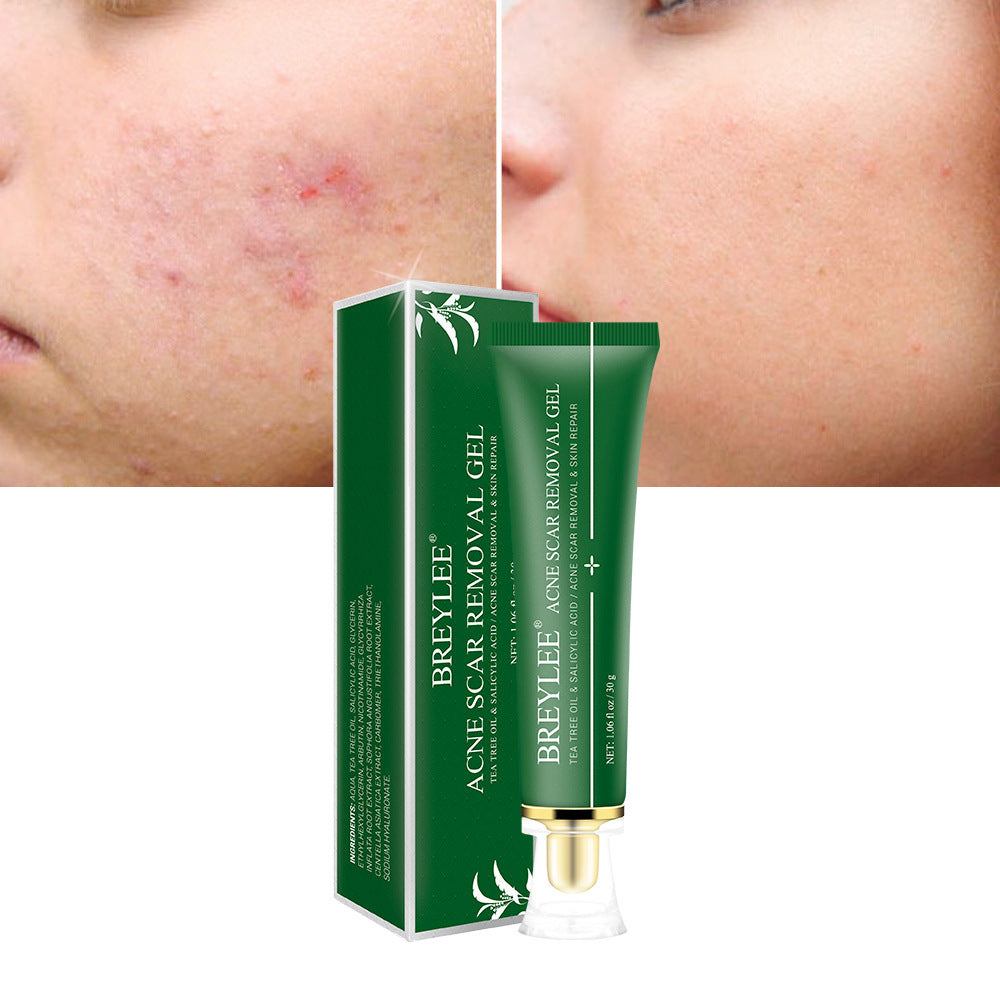 Acne Scar Removal Gel - ShreeBliss
