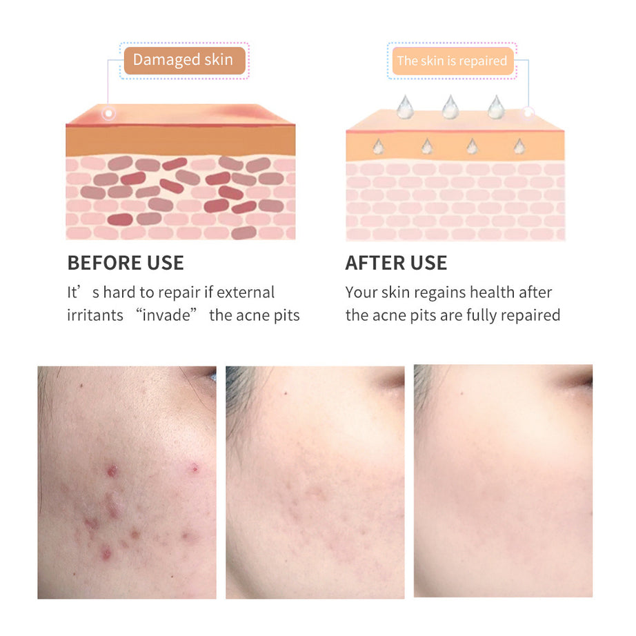Acne Scar Removal Gel - ShreeBliss