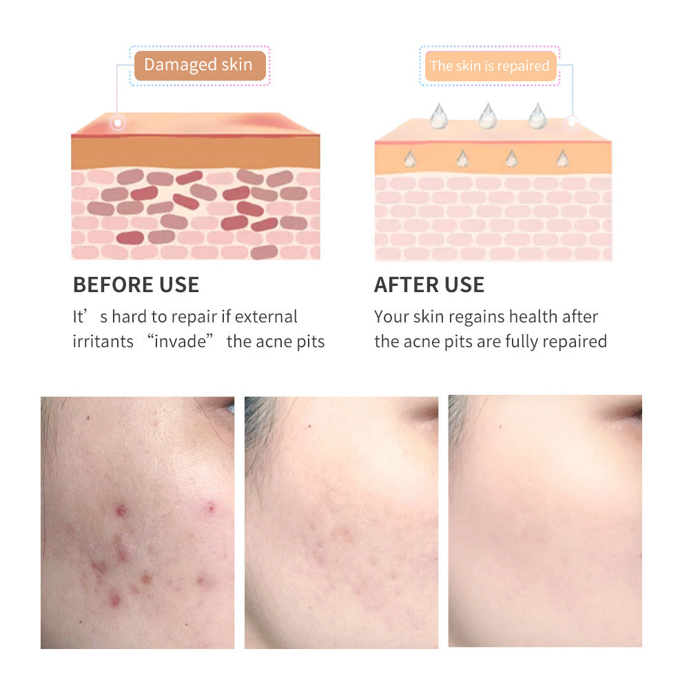 Acne Scar Removal Gel - ShreeBliss
